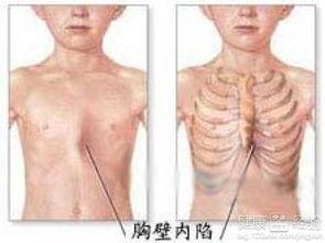 成人鸡胸矫正操作流程视频,成人鸡胸矫正操作流程详解